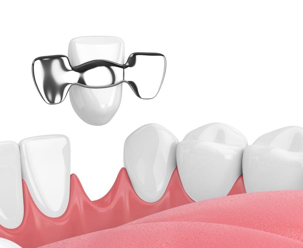 Temporary Maryland bridge after tooth extraction