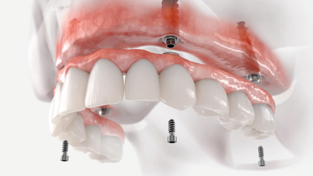 All-on-4 restoration for complete tooth loss