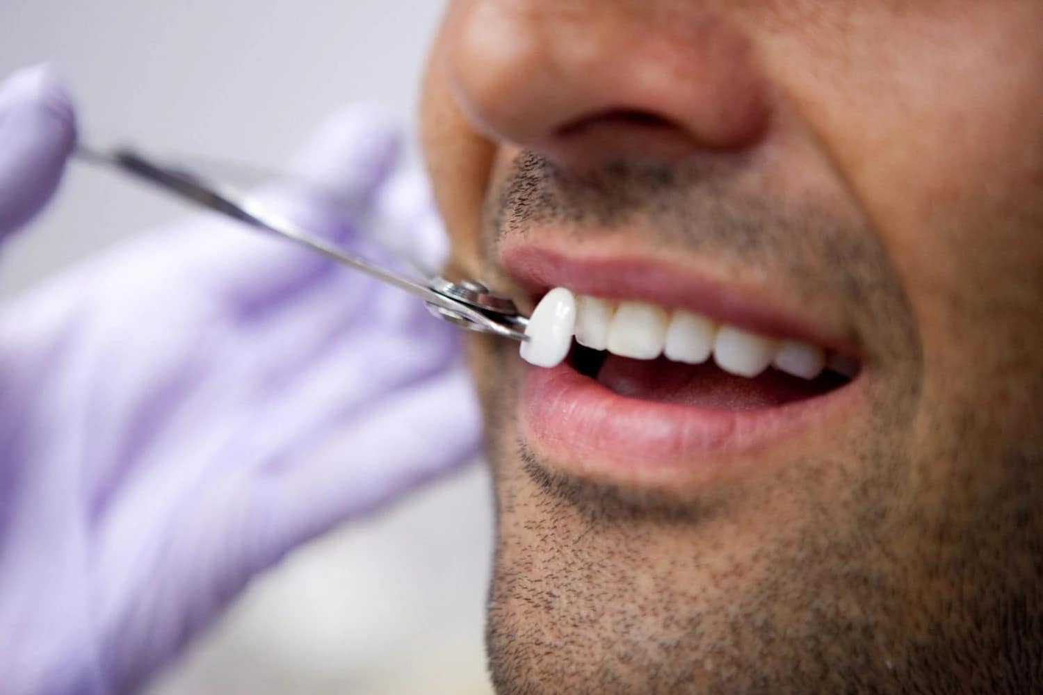 Making ceramic veneers at a cosmetic dental clinic