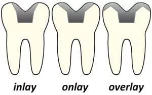 Inlay-onlay-overlay különbségek