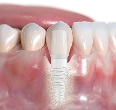 Consultation before dental implant placement