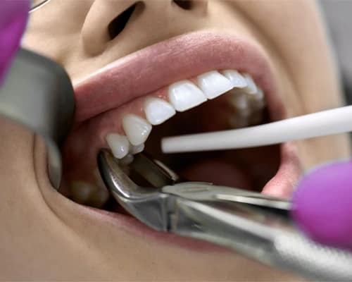 Fast healing after gentle surgical tooth extraction