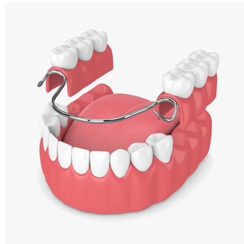 Partial prosthesis for missing teeth