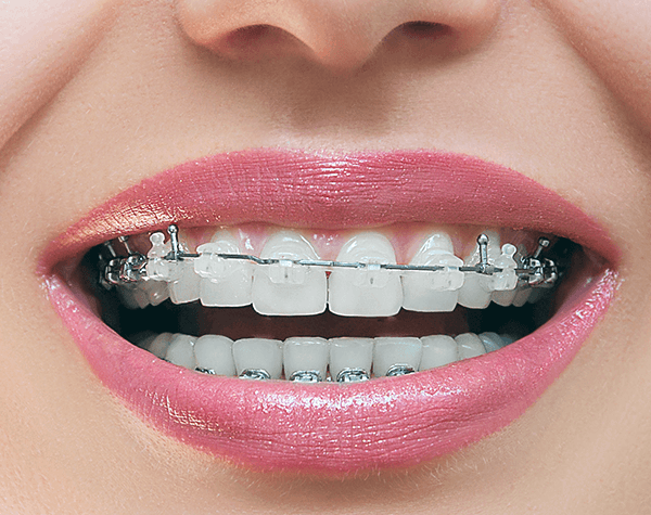 Damon Clear braces
