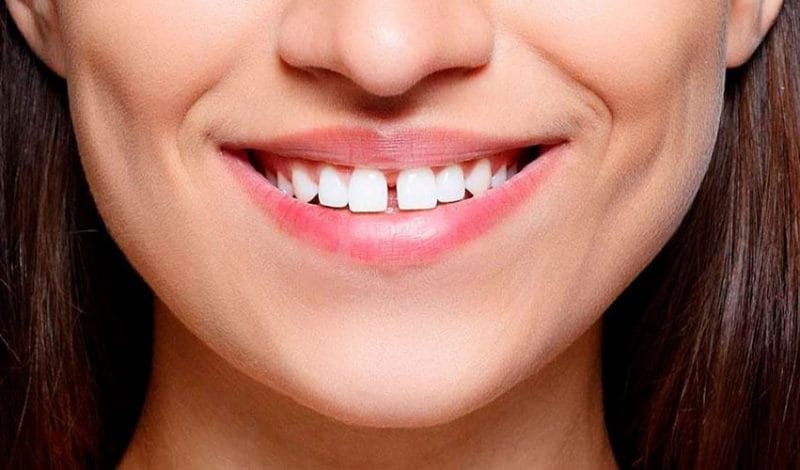 Dental veneers to close gaps between teeth