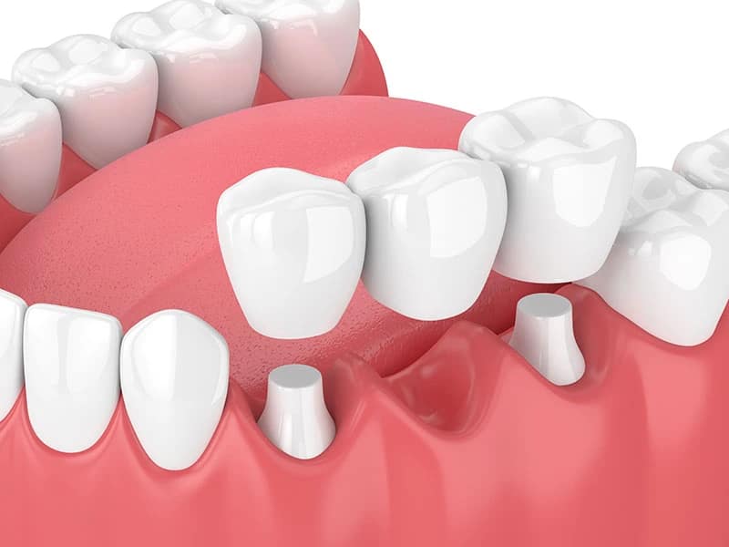 Traditional dental bridge