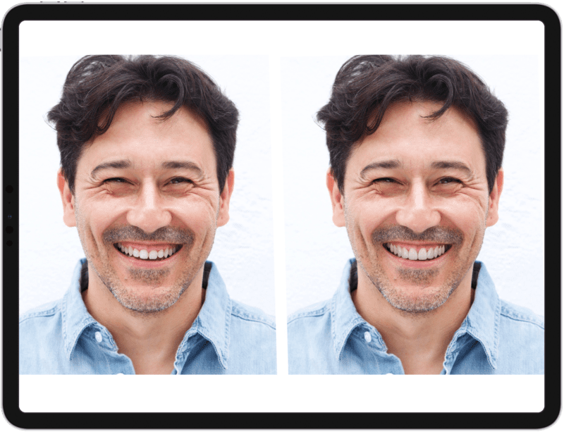 Digital visual preview with a smile designer